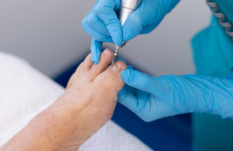 Reeducación ungueal (ortonixia) en el Centro Médico del Pie Dra Rita Rottier