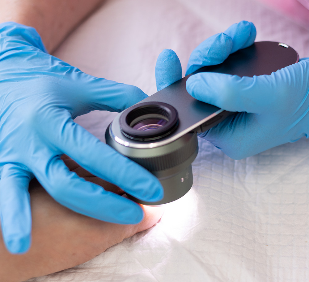 Tratamiento para hongos en las uñas en el Centro Medico del Pie Dra Rita Rottier