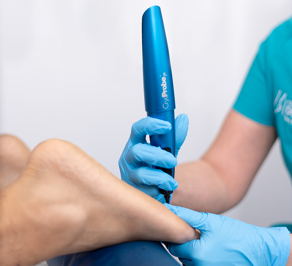 Tratamiento para verruga plantar en el Centro Medico del Pie Dra Rita Rottier